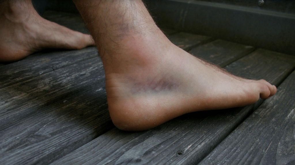 Bruised-Ankle-1024x576