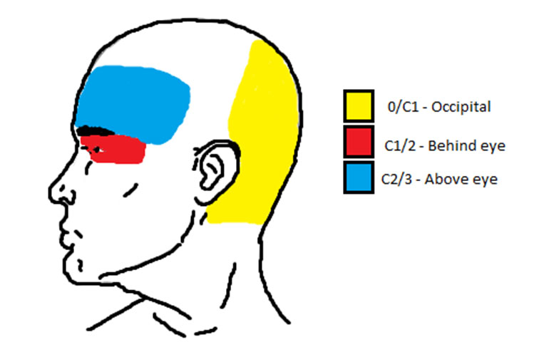 Cervicogenic-headache