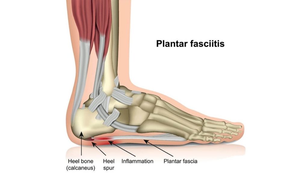 Plantar-Fasciopathy-Anatomy-1024x576