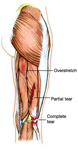 overstretch-partial-and-complete-tear